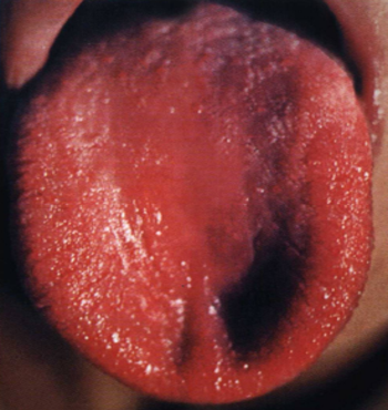 língua vermelho escuro